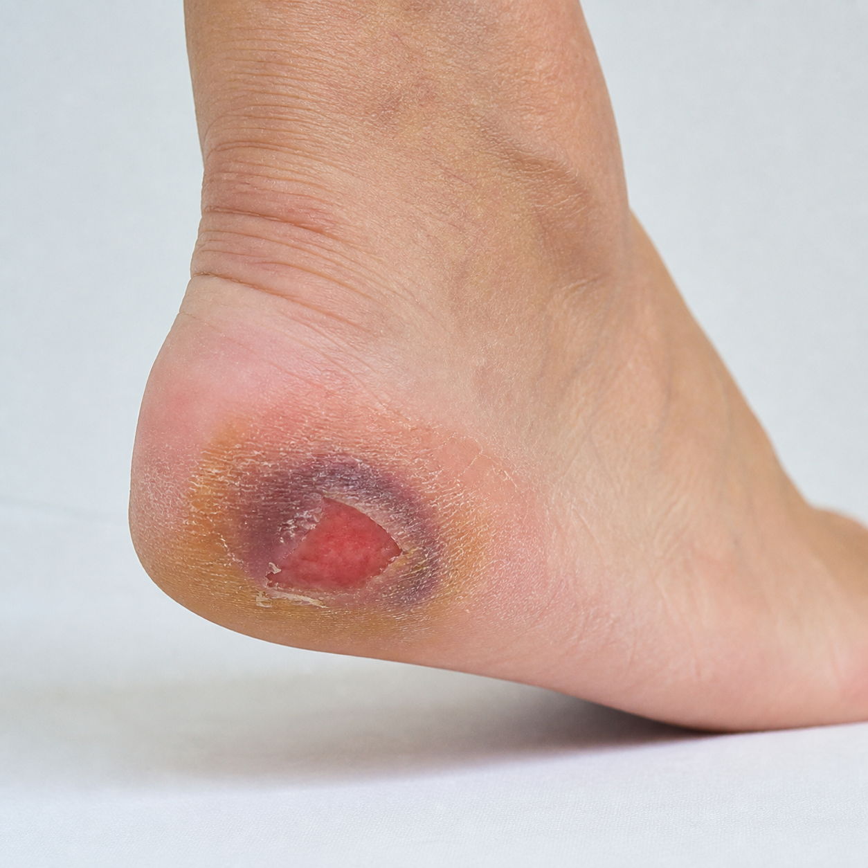 Clinical image representing pressure injury care